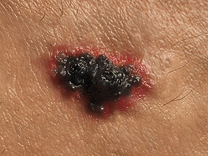 Skin Cancer Types: Melanoma