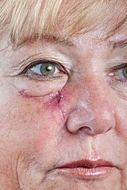 Skin Cancer Types: Basal Cell Skin Cancer (BCC) Female face, eyelid