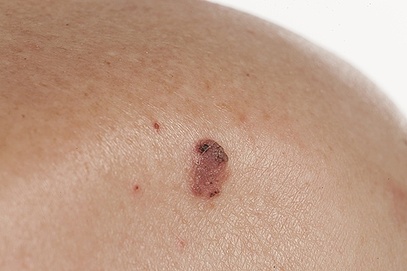 Skin Cancer Types: Squamous Cell Skin Cancer (SCC) - shoulder