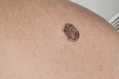 Skin Cancer Types: Squamous Cell Skin Cancer (SCC)