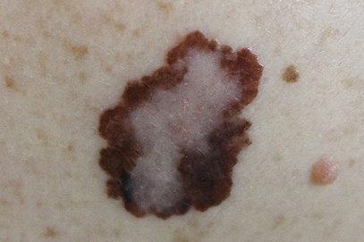 Skin Cancer Types - Melanoma