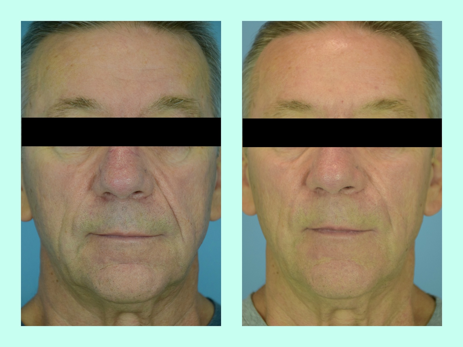 Male face, before and after Liquid Facelift treatment, front view