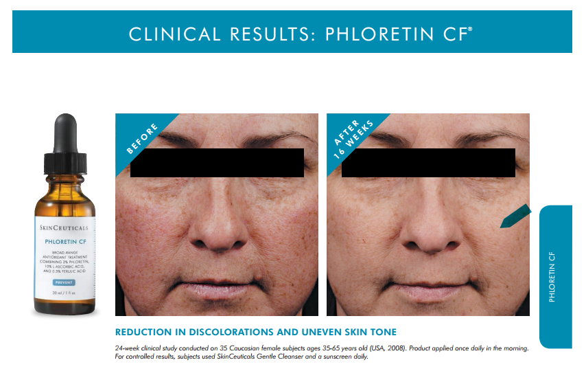 Clinical Results: Phloretin CF, Woman's face, before and 16 weeks after treatment, front view
