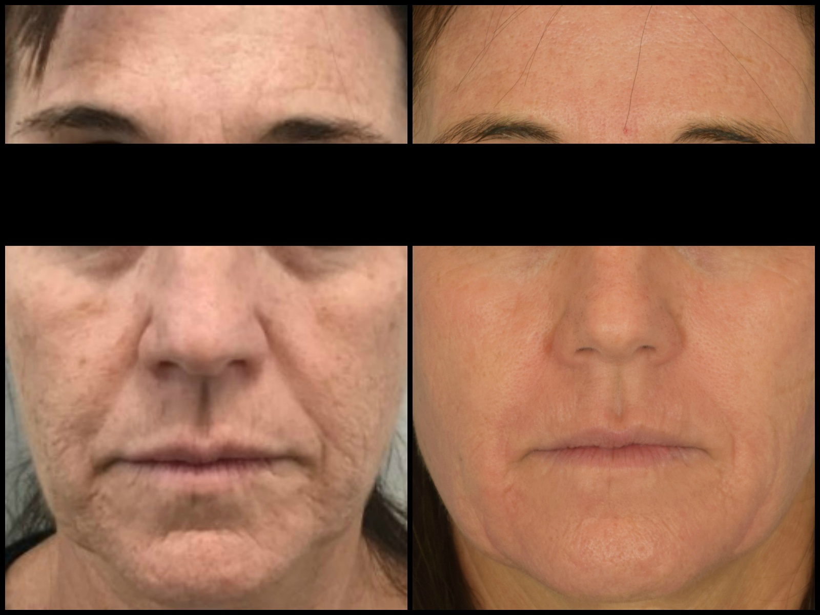 Woman's face, before and after Laser Treatment – CO2RE, front view