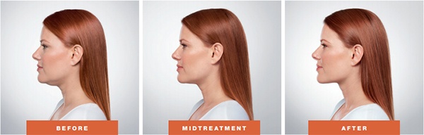 Woman's face, before, midtreatment and after kybella treatment, l-side view