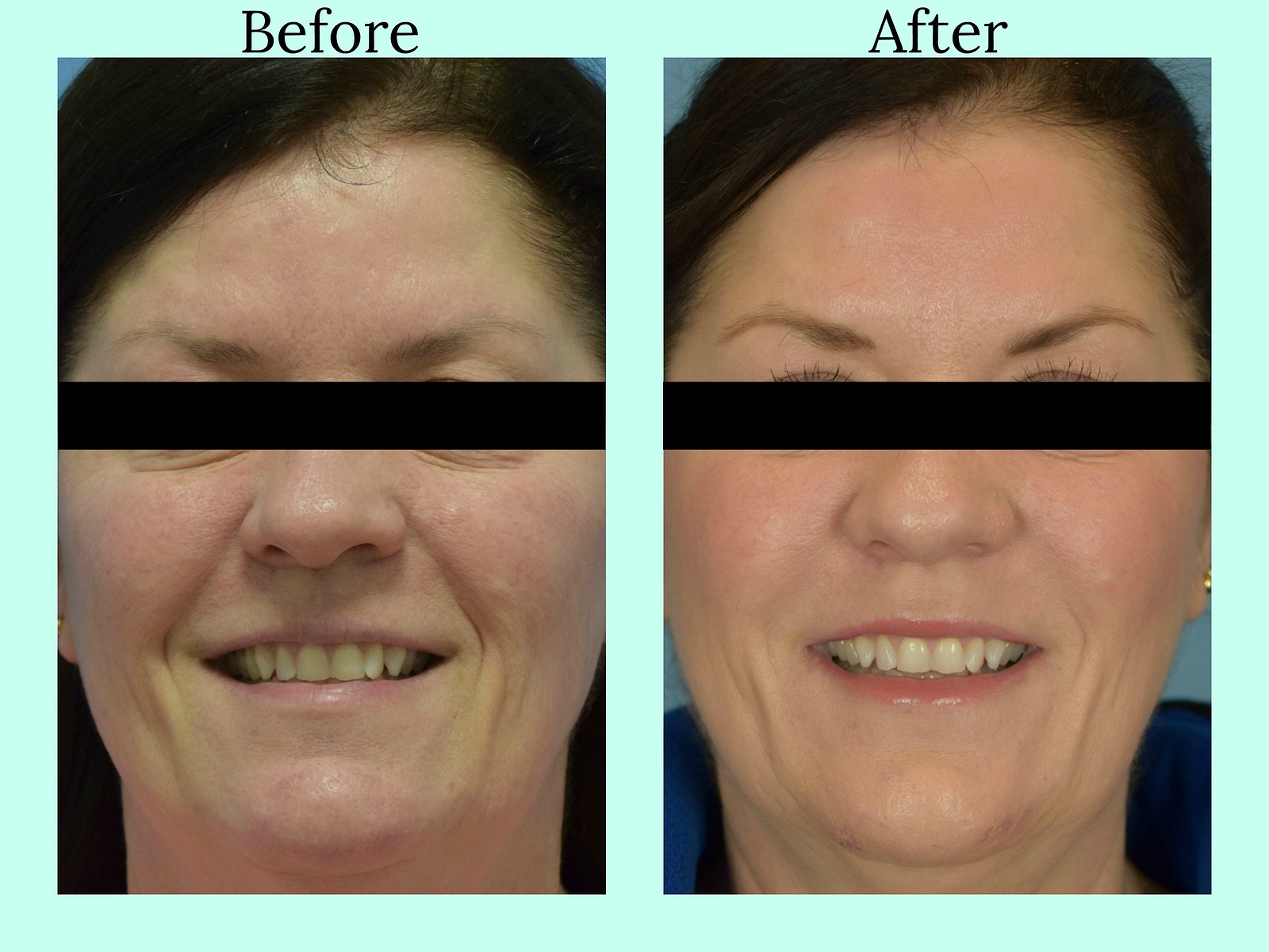 Woman's face, before and after Liquid Facelift treatment, front view