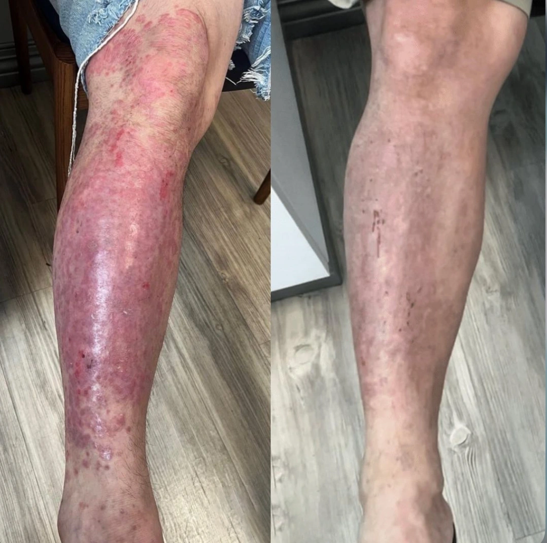 Psoriasis Specialist in Tampa BA 1 photo