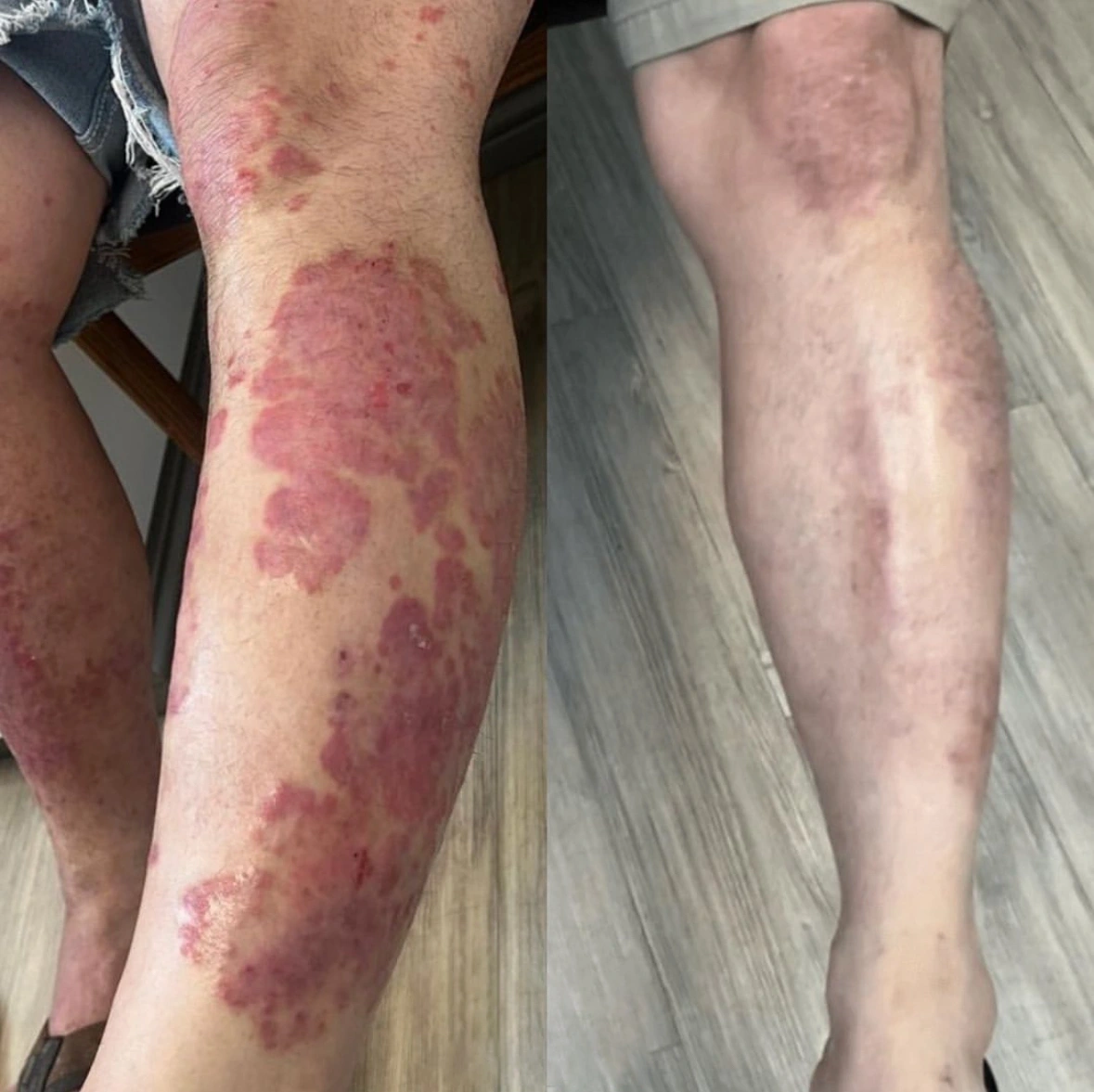 Psoriasis Specialist in Tampa BA 1 photo